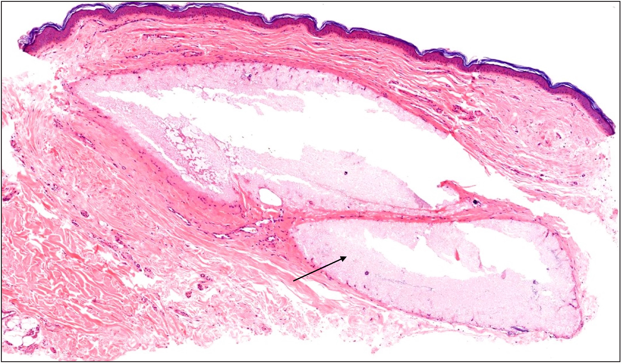 Deposition of well-circumscribed pools of lightly basophilic acellular, finely granular to amorphous mucin-like material (black arrow) in upper dermis (Haematoxylin & Eosin, 100x).