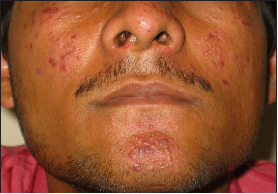Multiple skin-coloured to erythematous papules with areas of pock-like scarring over the cheeks and chin in an adult male with lupus miliaris disseminatus faciei.