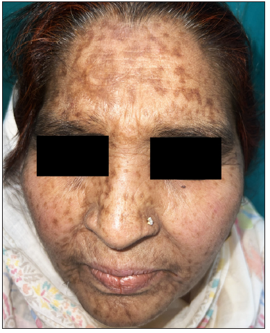 Multiple hyperpigmented depressed scars on the face of a 71-year-old woman who had smallpox at 7 years of age.