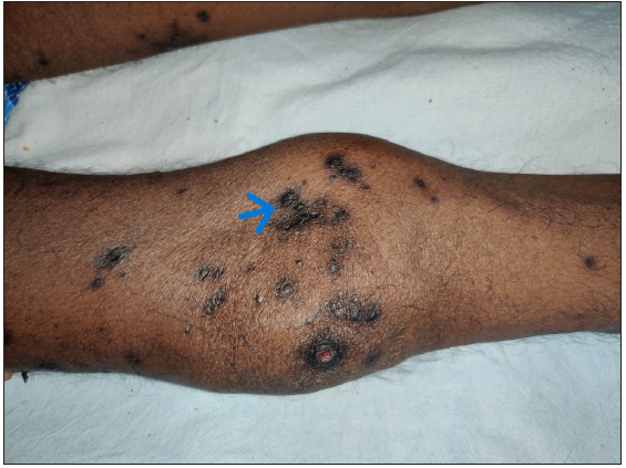 Multiple hyperpigmented papules and nodules with central keratotic plug in a patient with acquired perforating dermatosis secondary to chronic kidney disease. Few scattered atrophic hyperpigmented scars are noted over the right knee (blue arrow).