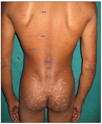 Scattered pock-like scars on the back of an adult male with lipoid proteinosis (arrows).