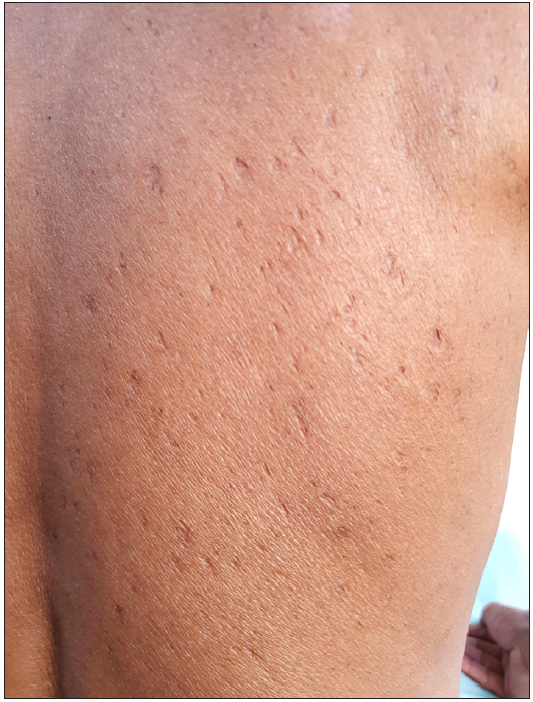 Multiple atrophic varioliform scars on the back after resolution of acne necrotica in an adult male.