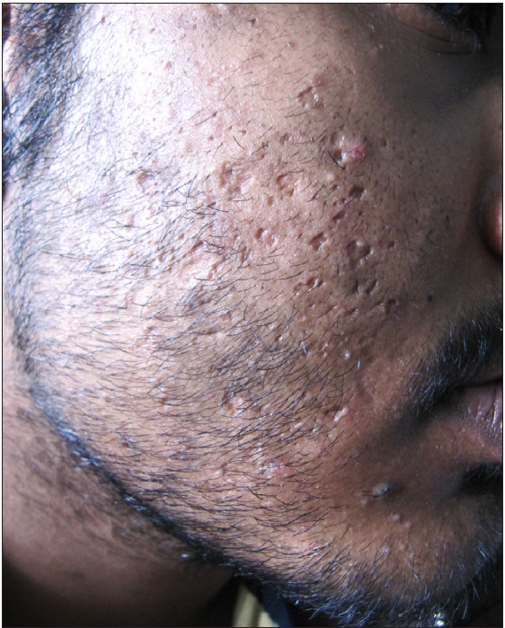 Typical ice pick and boxcar scars of varying sizes and shapes with active acne in an adult male.