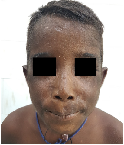 Multiple linear and shallow atrophic scars with waxy induration of skin on the face of a young boy with congenital erythropoietic porphyria.