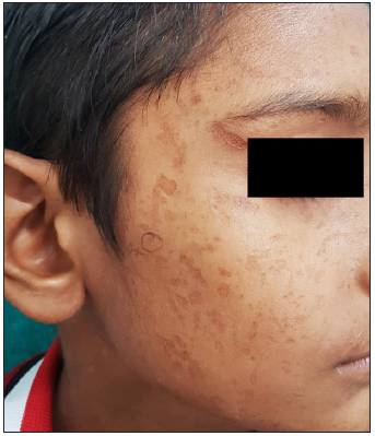 Multiple skin-coloured and hyperpigmented, shallow, punctate, linear and curvilinear atrophic scars of varying sizes in a boy with atrophia maculosa varioliformis cutis.