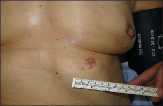 Left submammary papulonodular lesion compatible with dermatofibrosarcoma protuberans.