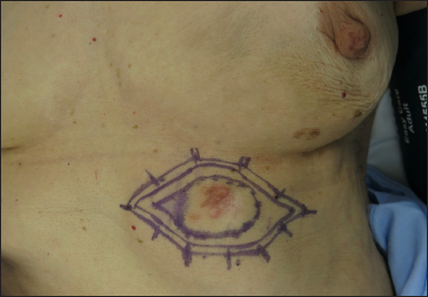Marking of the lesion.