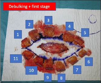 Histological representation of the first stage of Mohs surgery obtained with a double scalpel in a dermatofibrosarcoma protuberans of the trunk. Note that the debulking has been performed and that there are 12 histological pieces, one corresponding to the deep margin (thoracic deep fascia) and 11 to the lateral margins arranged in an orderly clockwise fashion. The pieces have an ideal size for their introduction into histological cassettes.