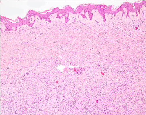 Histological sections of a dermatofibrosarcoma protuberans obtained by Mohs surgery with the double scalpel with 4-mm separation. The neoplasm was in the dermis and was composed of a dense proliferation of spindle cells, monomorphic, with a large and elongated nucleus, constituting irregularly intertwined fascicules, following a storiform pattern. The stroma is scant, with the presence of intercellular collagen deposits and small capillaries also stain (Haematoxylin and Eosin; 20x).