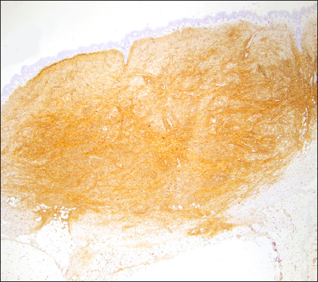 Histological sections of a dermatofibrosarcoma protuberans obtained by Mohs surgery with the double scalpel with 4-mm separation. The neoplasm was in the dermis and was composed of a dense proliferation of spindle cells, with large and elongated nuclei, arranged in irregularly intertwined fascicules, following a storiform pattern. The stroma is scant, with the presence of intercellular collagen deposits and small capillaries. CD34 staining is intensely positive (Haematoxylin and Eosin; 10x).