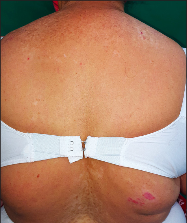 Erythematous papules of lichen planus colocalising over pre-existing vitiligo patches on relatively photo-protected site on back of patient 1.