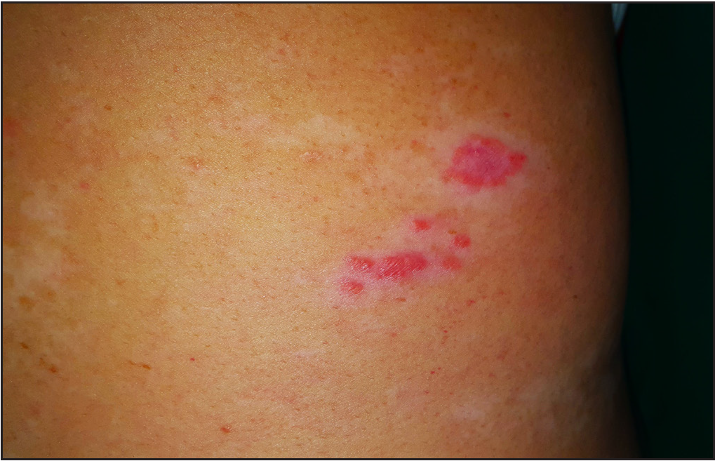 Close-up of colocalised lichen planus and vitiligo lesions on relatively photo-protected lesions of right lower back of patient 1.