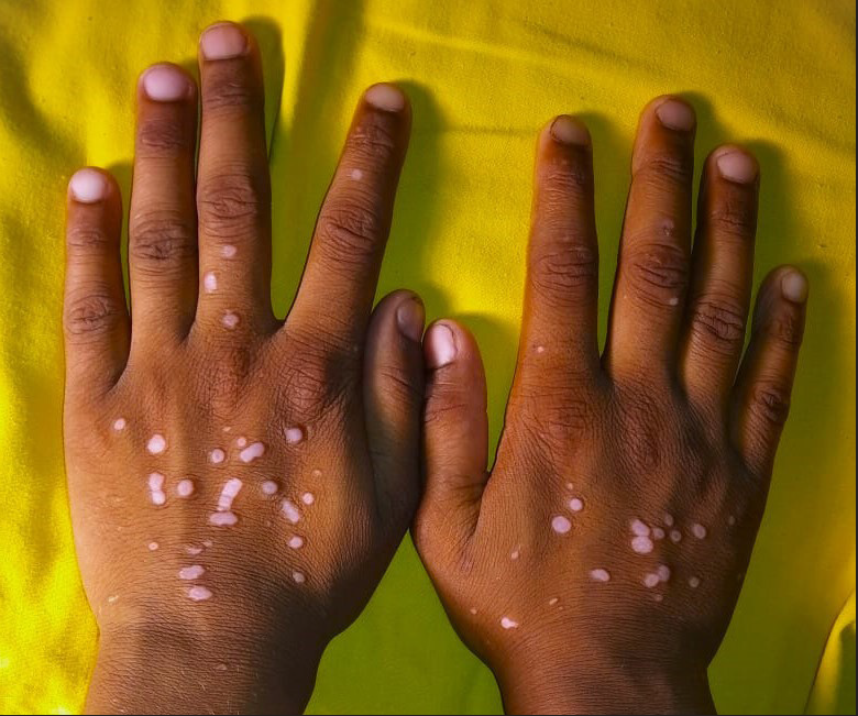 Raised lesions of lichen planus colocalising over pre-existing vitiligo on the dorsa of hands of a 9-year-old boy (patient 2).