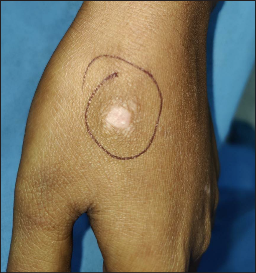 A small papule surrounded by smaller satellite papules due to lichen planus colocalising over pre-existing vitiligo on the dorsa of hands of a 21-year-old female (patient 3).