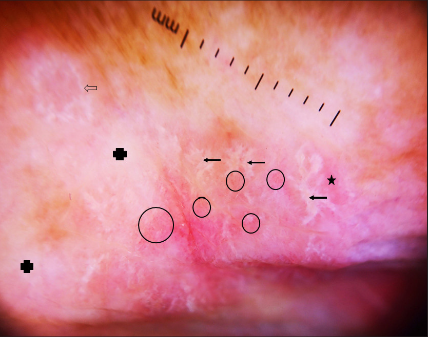 Dermoscopy of lichen planus colocalising over vitiligo in erythematous lesions of patient 1, showing multiple erythematous areas (star) with central whitish lines in a retiform, fern leaf–like branching pattern (arrow) and annular pattern (hollow arrow), suggestive of Wickham’s striae, surrounded by dotted and branched vessels (circle), with a background of depigmentation without any pigmentary network (solid cross). There were no dots or globules (Heine Delta 20 T, 10X).