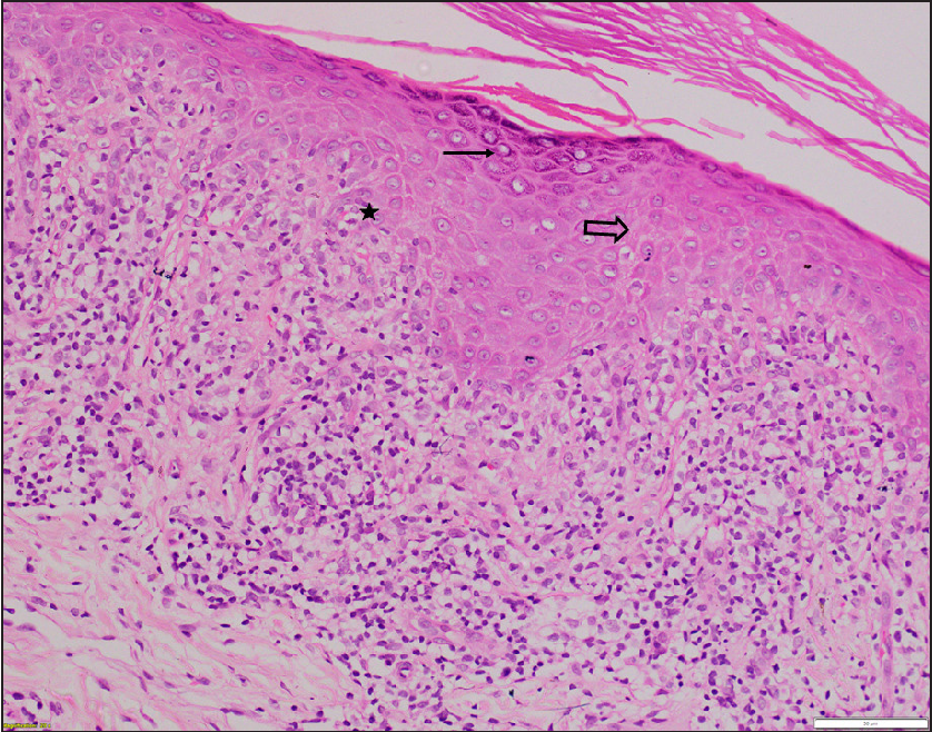 Histopathology of lesions of patient 1 showing hyperkeratosis, wedge-shaped hypergranulosis (arrow), necrotic keratinocytes in epidermis (hollow arrow), basal cell damage (star), and a dense band-like infiltrate of lymphocytes and histiocytes in upper dermis along with few colloid bodies suggestive of lichen planus. There were no melanophages in the upper dermis (H & E, x200).