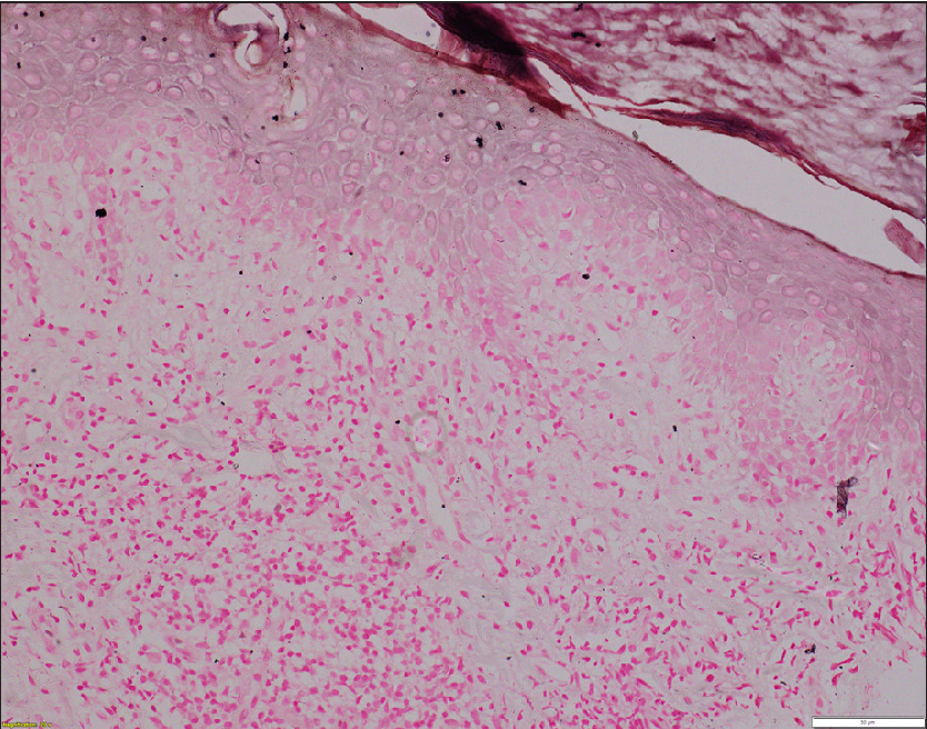 Histopathology of lichen planus colocalising with vitiligo of patient 3. No melanin is seen (Fontana-Masson stain, x200).