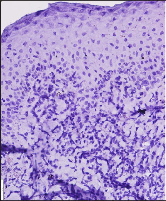 Histopathology of lichen planus colocalising with vitiligo of patient 3. No melanin is seen (HMB-45, x400).