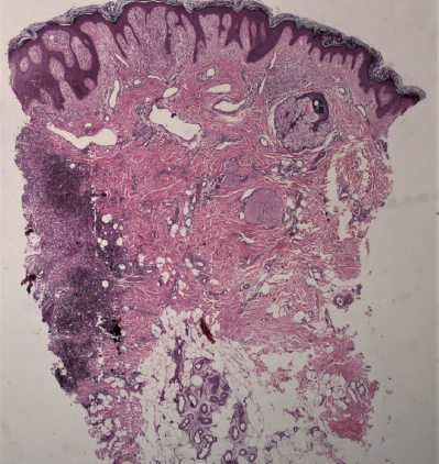 Skin biopsy from ulcerated plaque showing irregular acanthosis and papillomatosis with moderately dense inflammation at one end in the papillary dermis, extending to the deeper dermis (Haematoxylin and Eosin, 40x).