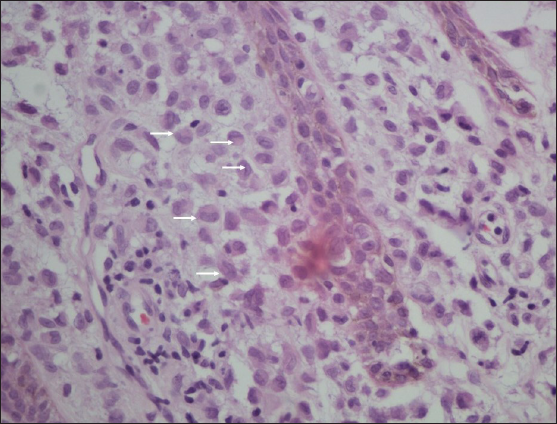 Higher magnification shows collection of Langerhans cells (white arrows) admixed with lymphocytes, histiocytes and plasma cells (Haematoxylin and Eosin, 400x).