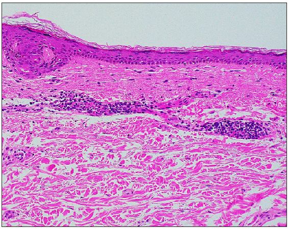 Histology from the macules demonstrating superficial perivascular lymphohistiocytic infiltrates with plasma cells, scattered eosinophils, and extravasated red blood cells (Haematoxylin & Eosin, 200×).