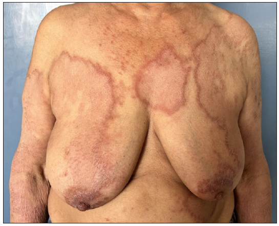 Case of borderline lepromatous leprosy with multiple large infiltrated and erythematous plaques.