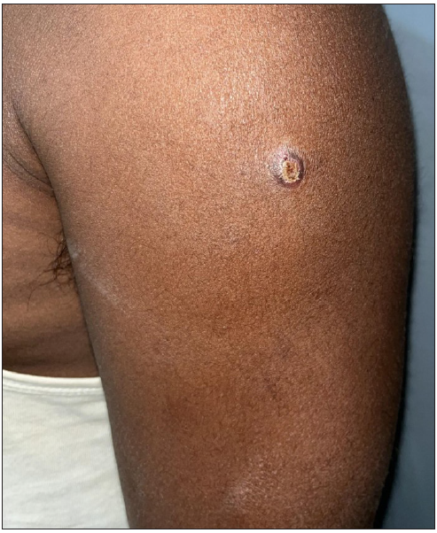 Nodulo-ulcerative lesion on the left arm – 2 weeks after administration of MIP vaccine.