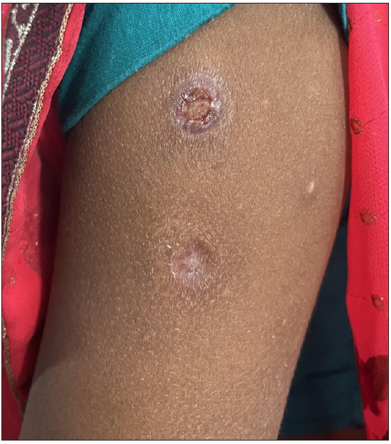 Superficial ulcer with surrounding erythema on left arm – 1 week after administration of MIP vaccine. Old healed scars can also be noted.