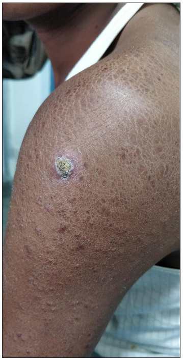 Patient with granulomatous dermatitis after MIP vaccination showing crusted erythematous nodule at the site of injection surrounded by ichthyosiform changes and multiple reddish-brown papulonodules on the left upper limb.