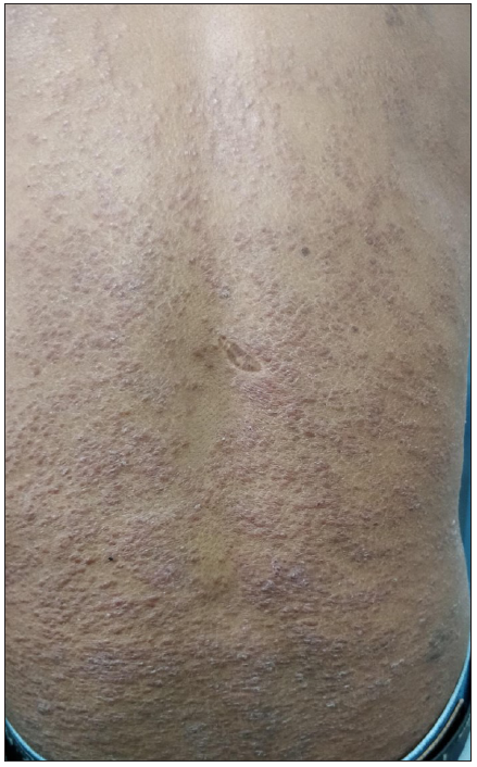 Patient with granulomatous dermatitis after MIP vaccination showing multiple reddish brown papules with superficial scaling on the back.