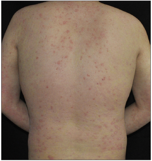 Paradoxical psoriasis was diagnosed after 5 weeks of treatment with ixekizumab in case 3.