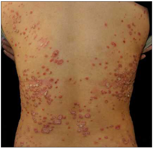 Plaque psoriasis was diagnosed at the initial visit in case 4.