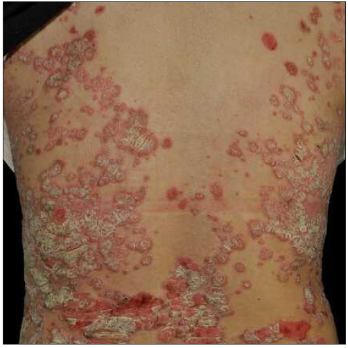 Paradoxical psoriasis was diagnosed after 5 weeks of treatment with ixekizumab in case 4.