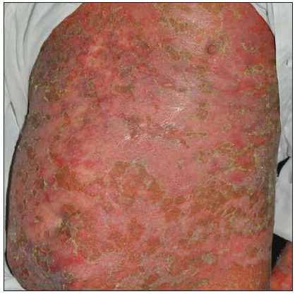 Paradoxical psoriasis was diagnosed after 1 month of treatment with ixekizumab in case 1.