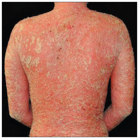 Erythrodermic psoriasis was diagnosed at the initial visit in case 2.