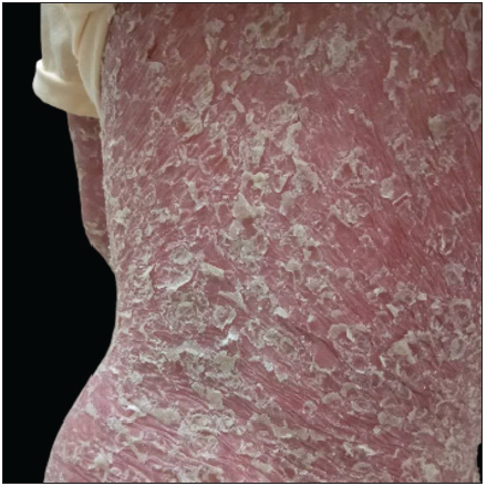 Paradoxical psoriasis was diagnosed after six weeks of treatment with ixekizumab in case 2.