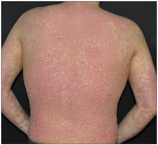 Plaque psoriasis was diagnosed at the initial visit in case 3.