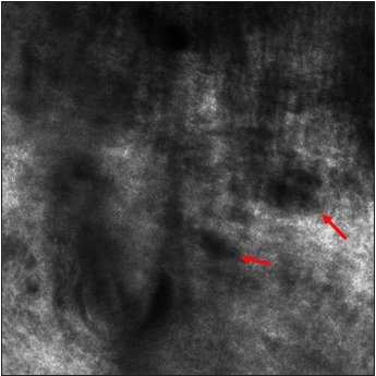 Oval dark spaces between irregular collagen fibers at higher magnification (red arrow).