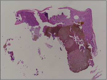 Yellowish brown amorphous material in the dermis; increased vascularity and inflammatory cell infiltrates (H&E, 40x).