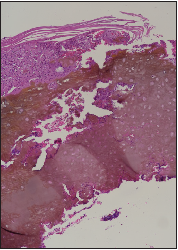 Yellowish brown amorphous material in the dermis; increased vascularity and inflammatory cell infiltrates (H&E, 100x).