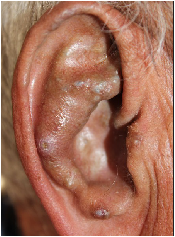 Bluish-grey nodular lesions on the right auricle.