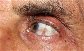 Yellow-brown discoloration in left conjunctiva.