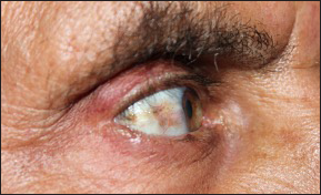 Yellow-brown discoloration in right conjunctiva.