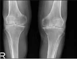 Osteophytic degenerative changes on direct radiography.