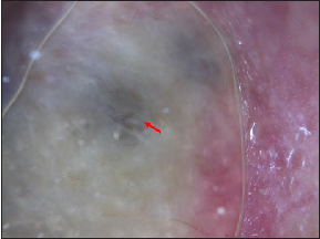 Homogeneous brown to grey-blue pigmentation (red arrow) (Dermlite DL4, polarised light)