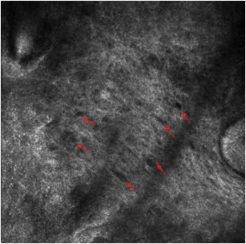 Oval dark spaces between irregular collagen fibers at lower magnification (red arrow).