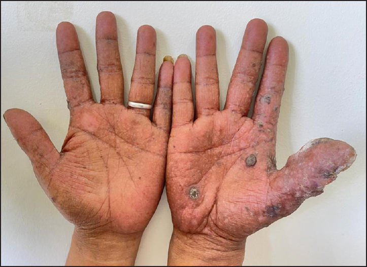 Poikiloderma and hyperkeratotic lesions involving the palms (more on the right hand side).