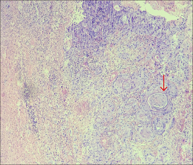 Histological examination showing atypical keratinocytes with prominent mitotic activity. Multiple keratin pearls (Red arrow) and areas of necrosis are also seen (Haematoxylin and Eosin: 100x).