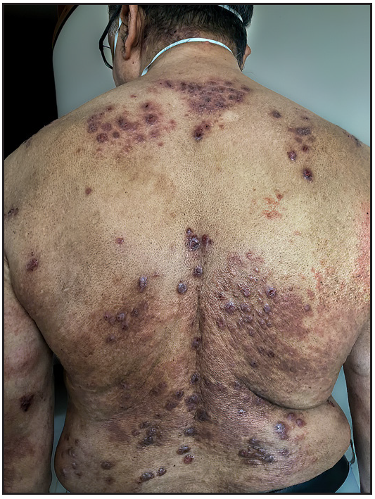 Excoriated papulonodular lesions on an eczematous base involving the back and sparing the butterfly area of the back.