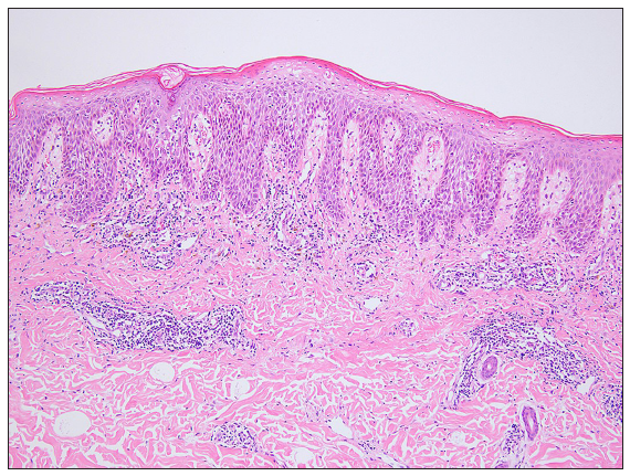 Patient 8: Epidermal hyperkeratosis, parakeratosis, irregular epidermal thickening, necrosis of superficial keratinocytes, intercellular edema, lymphocyte migration, basal cell degeneration, perivascular infiltrate of lymphohistiocytic cells and neutrophils, and nuclear dust (Haematoxylin and Eosin, 100x).